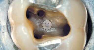 Le nuove punte da ultrasuoni per la rifinitura della cavità d’accesso A-C Tips