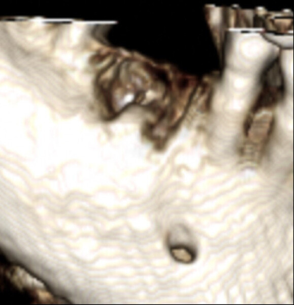 Figs. 9a & b: Osteonecrosis after extraction of the mandibular first molar.
