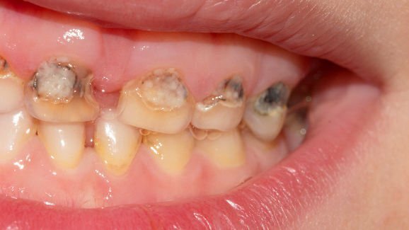 Оралните бактерии на майките могат да предскажат риска от кариес на ранното детство