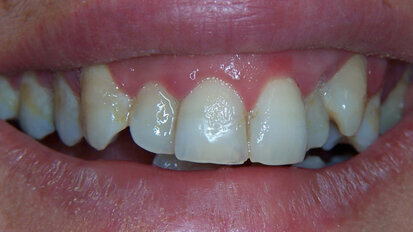 Clinical management del paziente con affollamento dentale