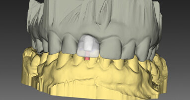 Využití současných technologií a digitálních řešení v okamžité jednodobé implantaci