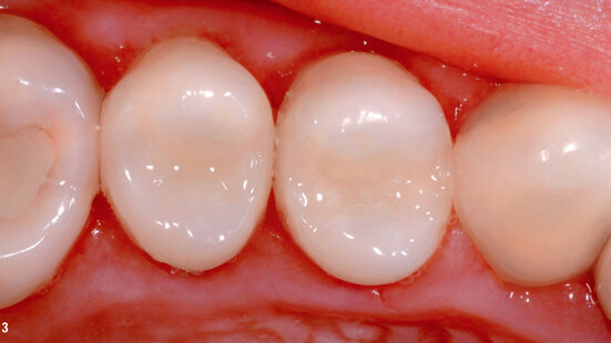 The renaissance of a classic: Tetric-N Ceram—a perfect combination of experience and innovation