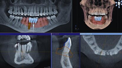 CBCT-assisted implant therapy: A case study