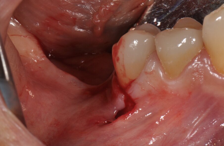 Figg. 3, 4_Come previsto dalla procedura di GBR Pocket Technique, si esegue un’incisione minimamente invasiva con estensione vestibolare e linguale.