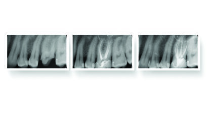 Revolutionizing Endodontics with Fotona SWEEPS Technology