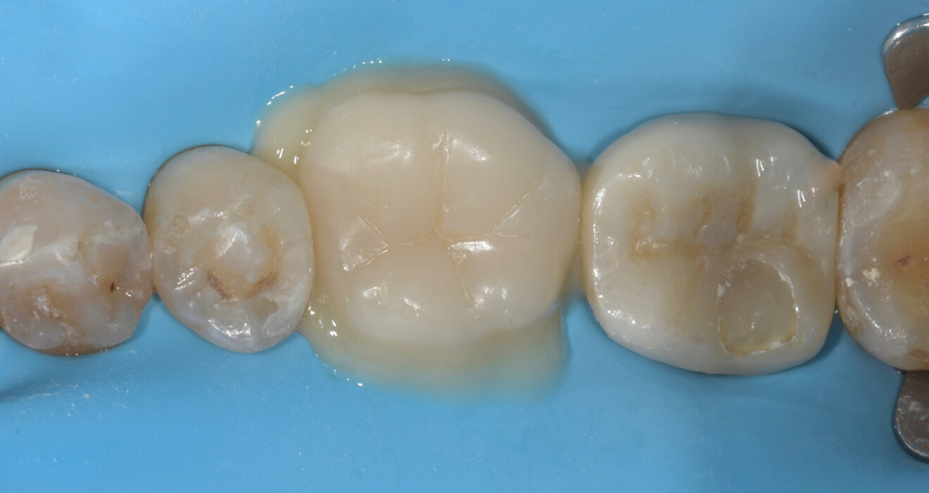 Fig. 24a: Endocrown after seating with heated composite.