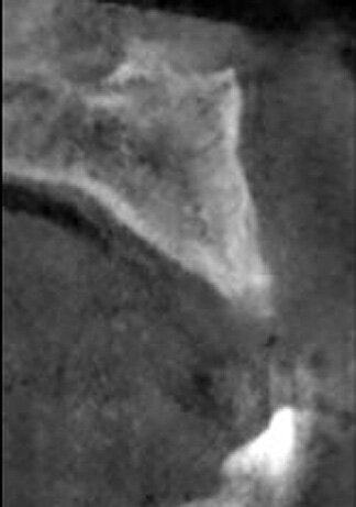Fig. 16: CBCT cross-section of the grafted facial aspect of the deficient ridge demonstrates adequate width for implant placement following healing of the graft at 4.5 months.