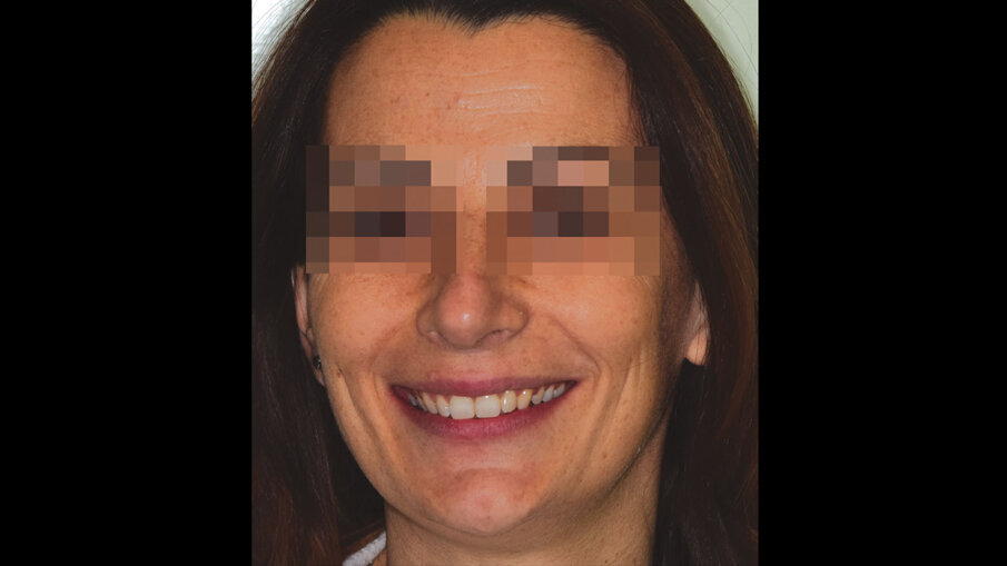 Figg. 8a-8c_Foto extraorali di fine trattamento.