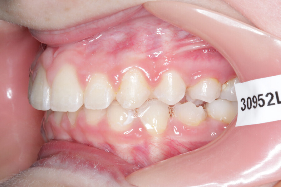 Fig. 4: Initial situation. Class II malocclusion patient.
