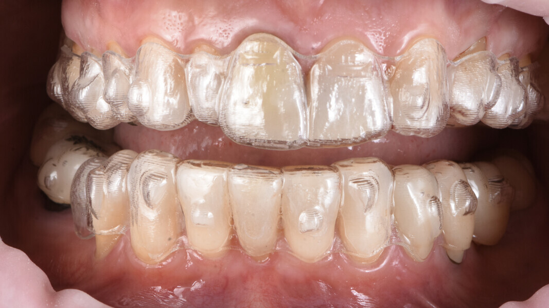 Fig. 8: Start of the Invisalign therapy.