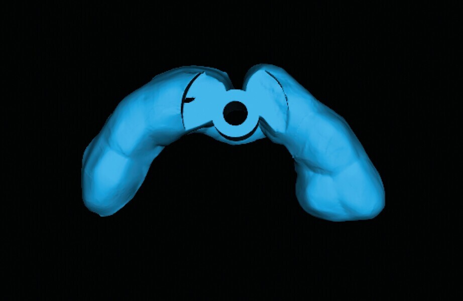 Fig. 10b : Un guide avec forage pilote est fabriqué d’après les reconstructions CBCT en 3D.