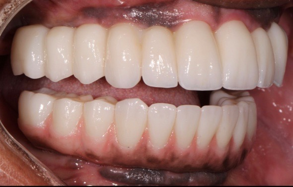 Fig. 34: Right lateral view of the completed case.