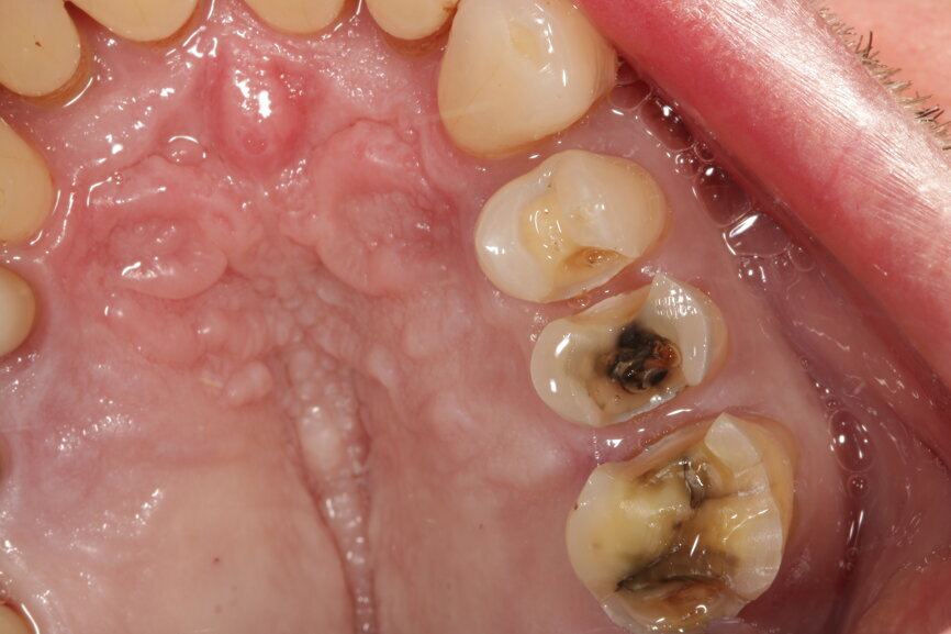 Fig. 3a: The
prepared teeth are readied for intraoral digitalisation (intraoral scanning).