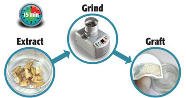 Dentists who are converting extracted teeth into bone graft report outstanding long-term results