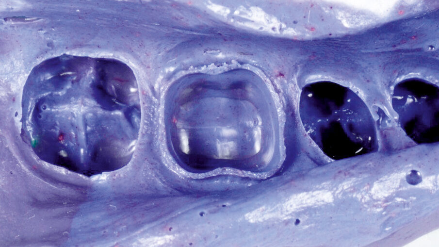 Fig. 7: Monophase impression taken with 3M™ Impregum™ Penta™ Soft Polyether Impression Material. A very detailed representation of the preparation margin is obtained with this simple technique.