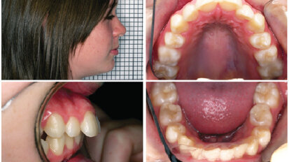 Recidiva: problém, o kterém se nikomu nechce diskutovat. Recidiva zůstává Achillovou patou ortodoncie, ale je skutečně tak těžké se o ní bavit?