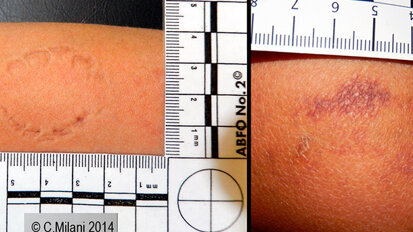 L’importanza dell’odontologo forense nell’analisi dei “bitemarks” per riconoscere le fattispecie di reato associate a maltrattamenti e/o abusi