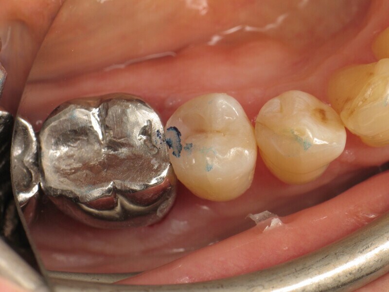Fig. 20 : Contrôle de l’occlusion avant retouche.