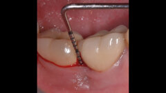 Perimplantite trattata con ozono stabilizzato in gel: case report