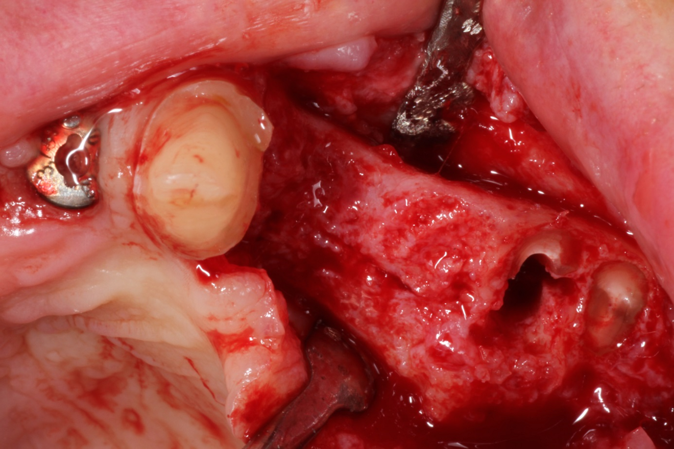 Fig. 12: Clinical situation during second-stage surgery after flap elevation, displaying proper bone regeneration in the premolar area after ridge preservation with autologous dentine.