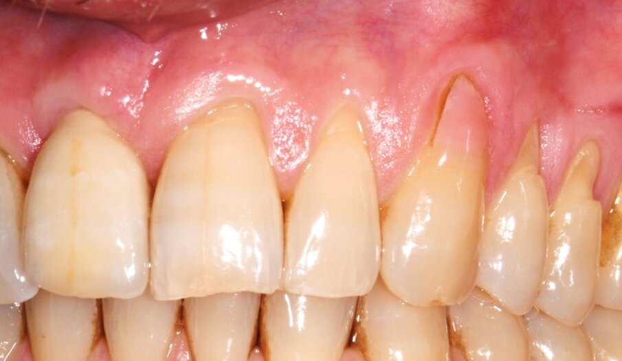 Fig. 2 - Sede delle recessioni da sottoporre a chirurgia MCAF: elementi 21-25 con presenza di NCCLs.