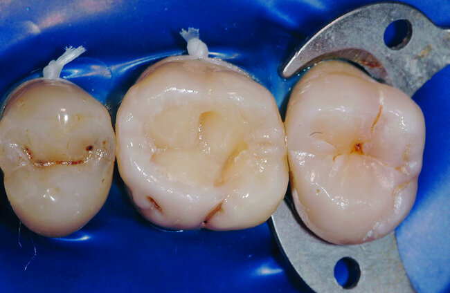Fig. 26: Vue occlusale après apport du troisième incrément de masse dentine. En réalisant des apports obliques de composite la situation plus favorable pour le facteur C et nous rendons la création d’une anatomie dentaire plus facile. Nous pouvons en effet voir se dessiner l’anatomie primaire de la première molaire. L’incrément dentine est appliqué uniquement au contact de la dentine. Il ne doit pas remonter trop haut sur la surface occlusale afin de laisser une épaisseur de 2 mm pour l’incrément email. 