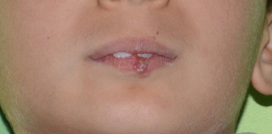 Figure 12: Healing of the lip one month post-op. Some oedema and scarring were noted