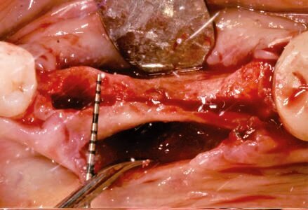 Fig. 10 - Espansione della cresta.