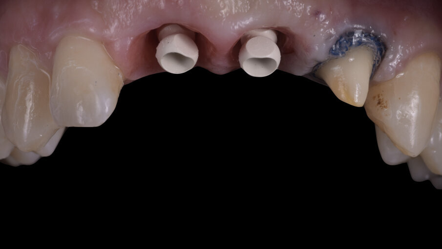 Fig. 4_Impronta master arcata superiore.