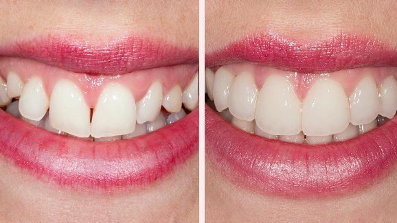 Von der Planung bis zur Realisierung: Experte referiert über Adhäsiv-Verfahren