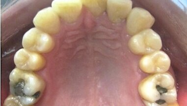 Ortodoncia invisible al alcance de todos