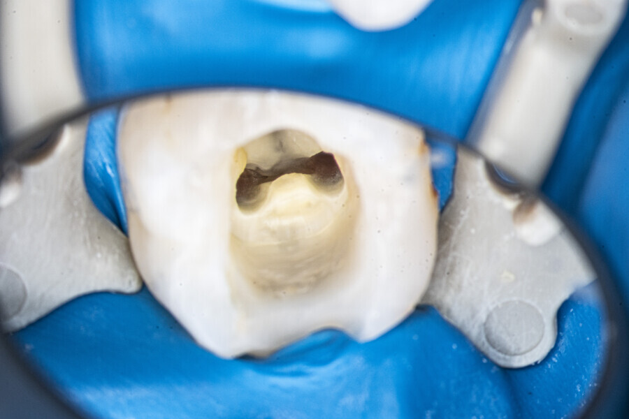 Fig. 30: The mesial canals after instrumentation.