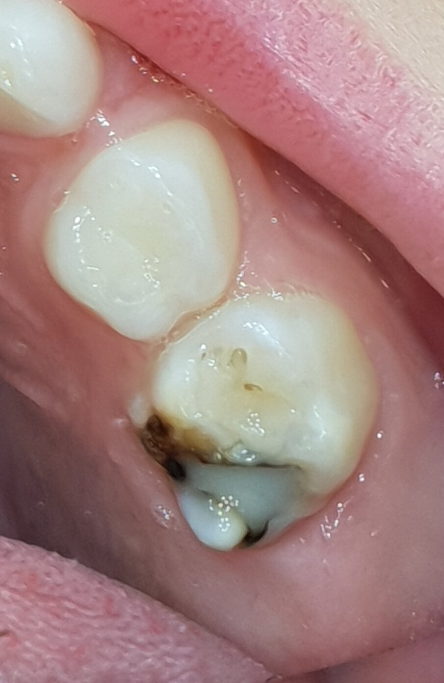 Afbeelding 4b. Resultaat SMART-methode in plaats van narcosebehandeling na drie jaar.