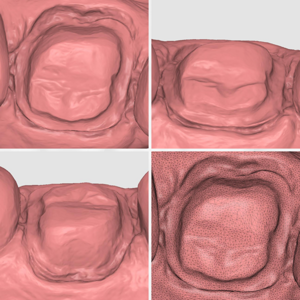 Fig. 6: Preparation margins on the TRIOS 5 scan.