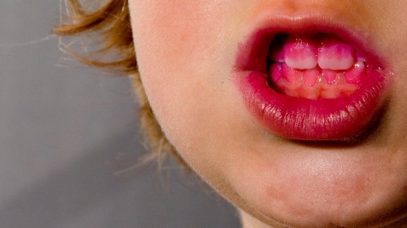 Grafeno reduz cárie e doença periodontal