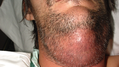 Manejo y prevención de infecciones odontogénicas