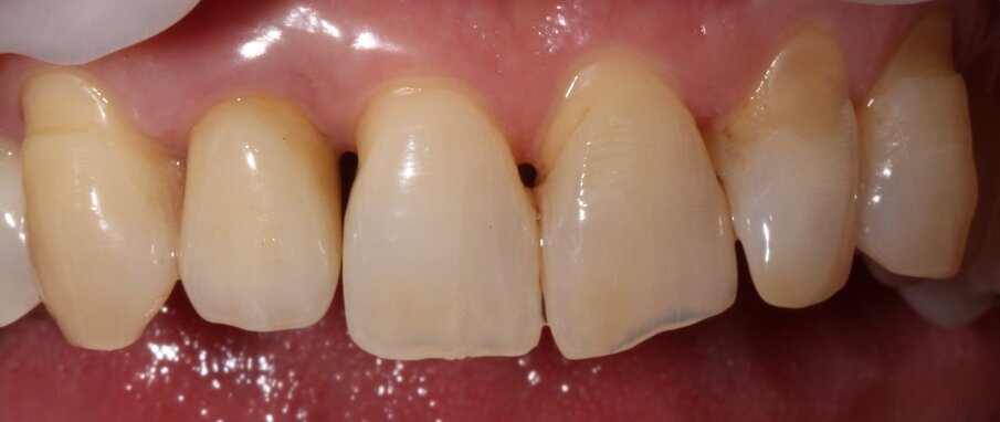 Fig. 8 - Follow-up 8 settimane, assenza di sanguinamento e riduzione dell’infiammazione.