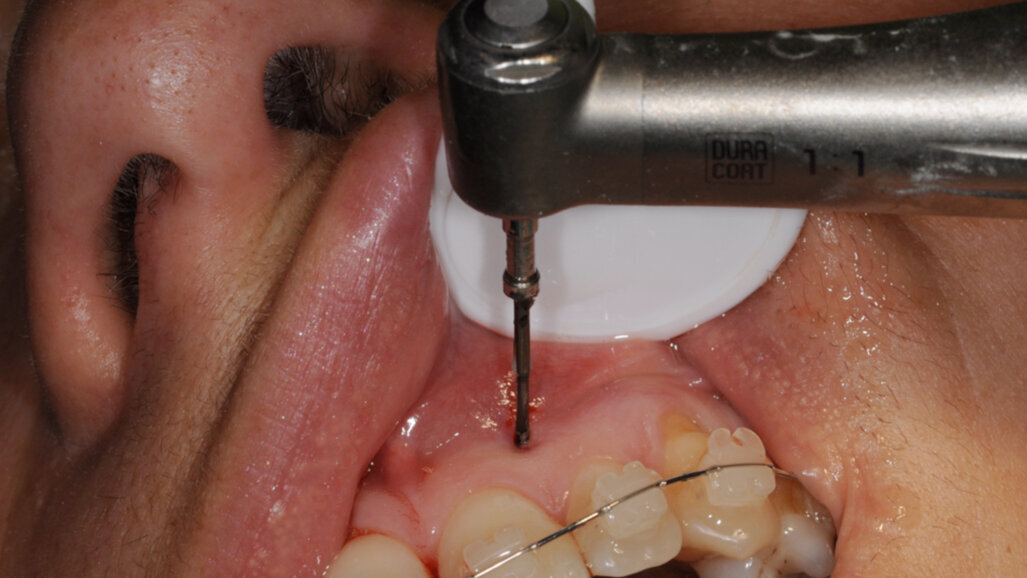 Ostéo-activation : dix-neuf ans de recul