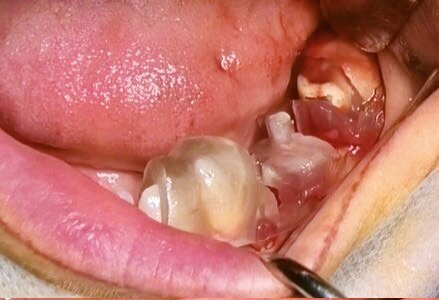 Fig. 9 - Alloggiamento dima chirurgica.