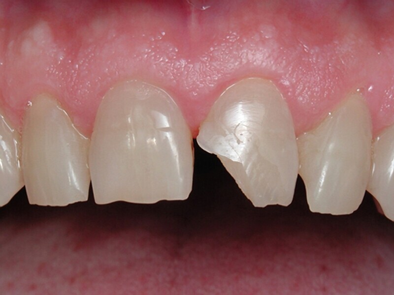 Figura 1. Diente central con fractura de ángulo.
