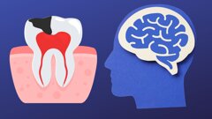 Impact of early childhood caries on mental development ​
