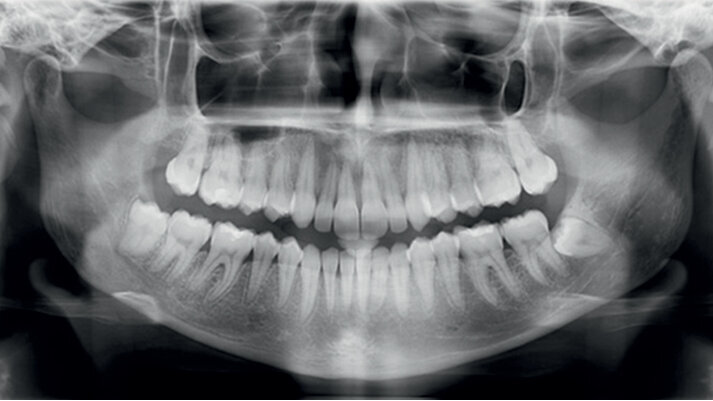 Distalizace horních molárů pomocí alignerů a cyklických sil