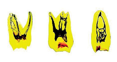 Il punto sull’irrigazione in endodonzia (prima parte)