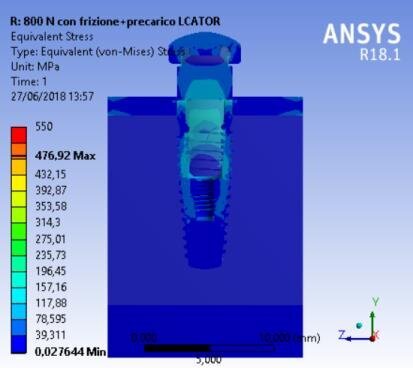 Fig. 9b - Von Mises results of the complex bone fixture and prosthodontics attachments, locator prosthesis.