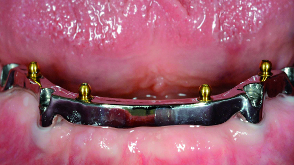 Evaluating the fit of removable dentures with magnification systems