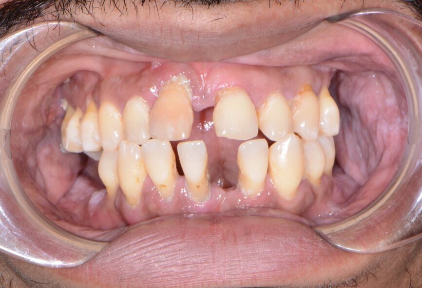 Fig. 2: Retracted pre-op frontal view.