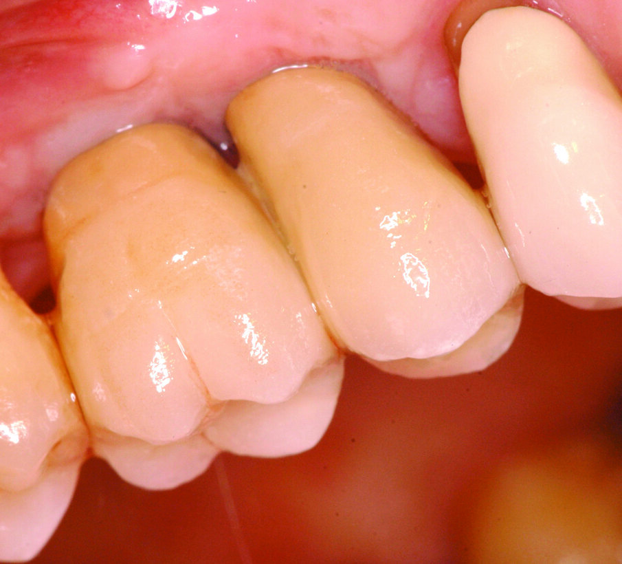 Figg. 13-15_Particolari dei monconi in titanio e delle corone in metallo ceramica.