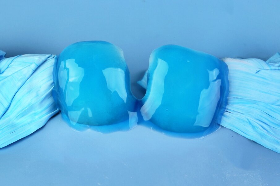 Fig. 4: Total etching completed with 37% Phosphoric acid.