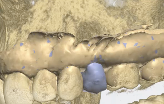 Fig. 7_Il progetto protesico integrato nel volume radiologico.