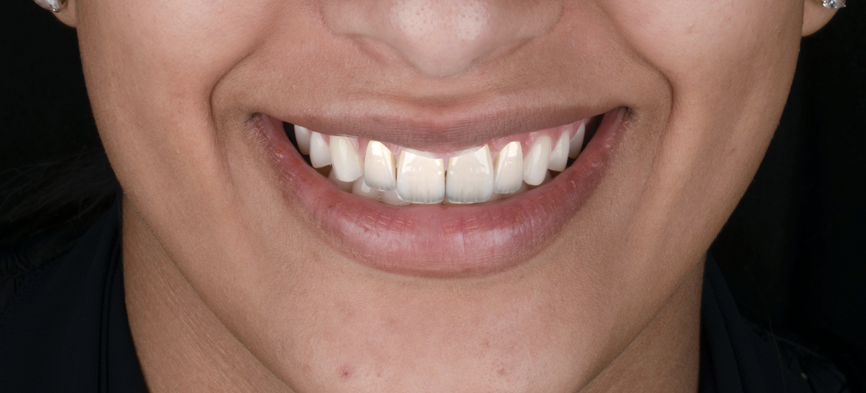 Fig 5:  Digital Smile Design 